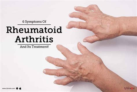 6 Symptoms Of Rheumatoid Arthritis And Its Treatment By Bansal