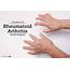 6 Symptoms Of Rheumatoid Arthritis And Its Treatment  By Bansal