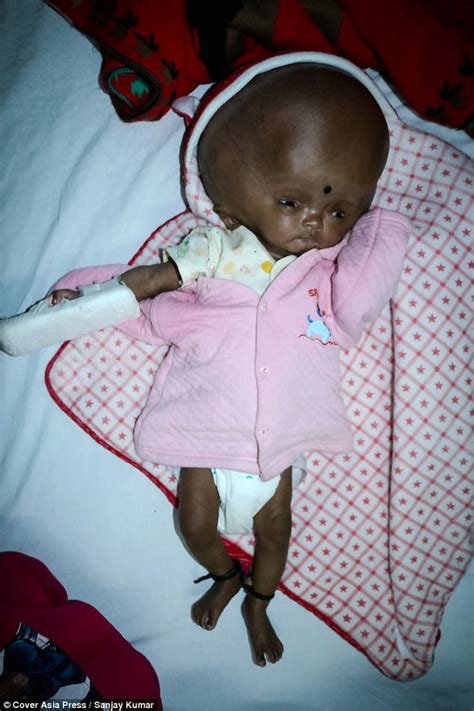 Indian Baby S Head Tripled In Size Due To Hydrocephalus Daily Mail Online