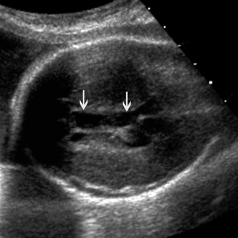 Normal Cavum Septum Pellucidum Ultrasound