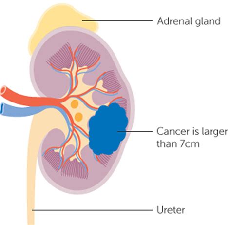 Kidney Cancer Causes Symptoms Signs Stages And Treatment