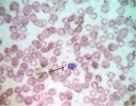 A Case Report Of Visceral Leishmaniasis And Malaria Co Infection With