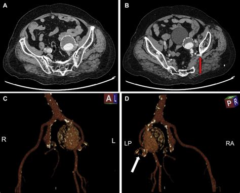 Therapeutic Management Of Isolated Internal Iliac Artery Aneurysms
