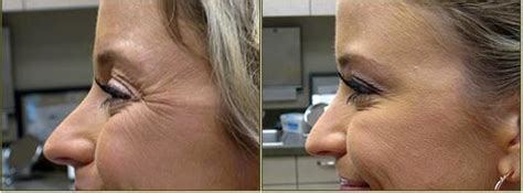 dr tricia brown dermatologist in houston tx crow s feet with dysport facial injections