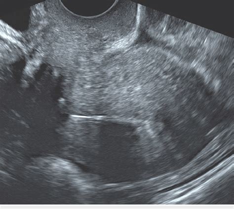Transvaginal Ultrasound Showing An Anteverted Uterus With The