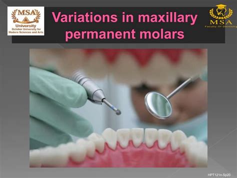 Variations In Maxillary Permanent Molars Ppt