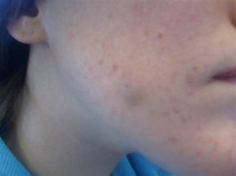Sebaceous Cyst Help Pictures General Acne Discussion