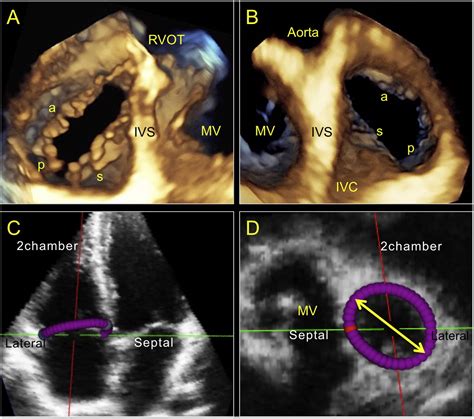 The Use Of Multimodality Cardiovascular Imaging To Assess Right