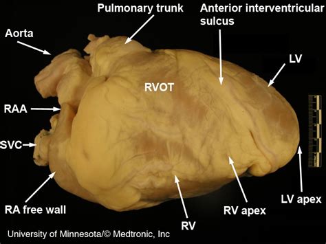 Pulmonary Trunk Atlas Of Human Cardiac Anatomy