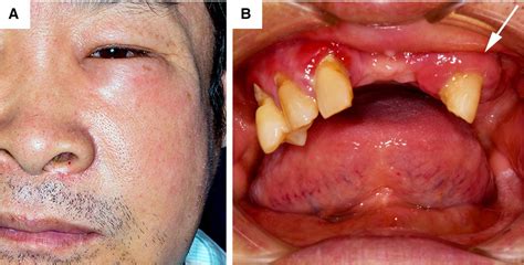 Cellulitis Vs Abscess Dental Facial Cellulitis Is An Infection Of The