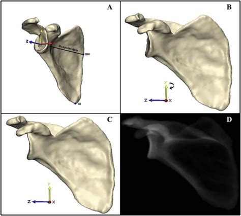 The Critical Acromial Point The Anatomic Location Of The Lateral