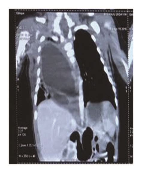 Computed Tomography Scan Showed A Well Defined Fluid Attenuation Lesion