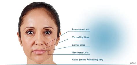 JuvÉderm Mouth And Nose Area Wrinkle Treatment