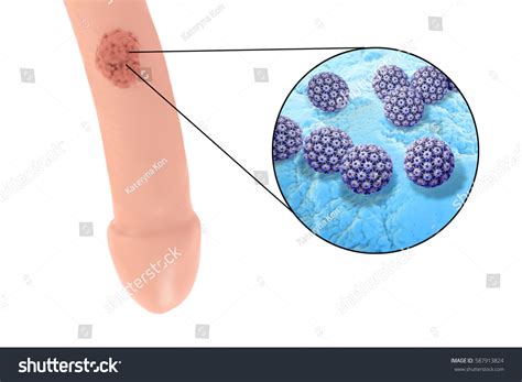 Common Locations Genital Warts Human Papillomavirus стоковая