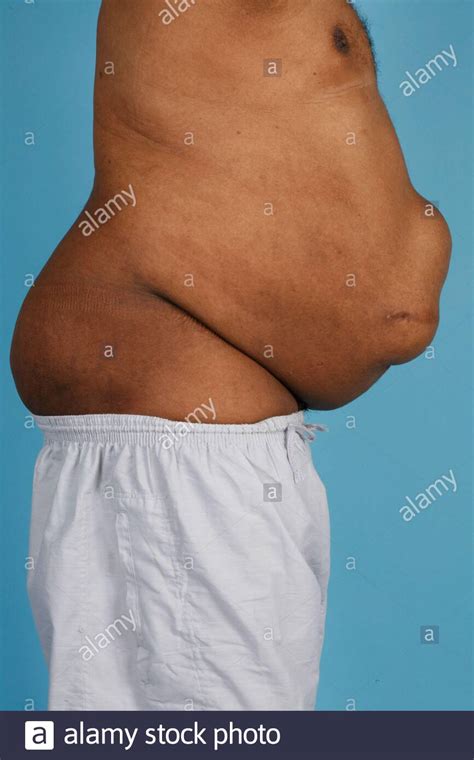 Hernia Abdomen Hi Res Stock Photography And Images Alamy