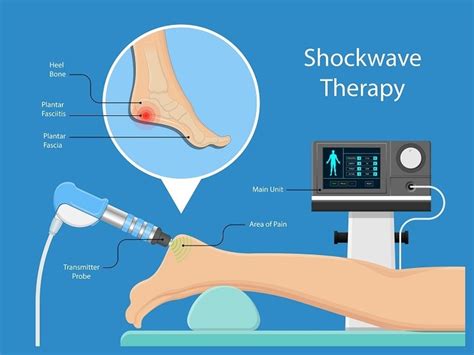 Shockwave Therapy For Plantar Fasciitis Thrive Now Physiotherapy