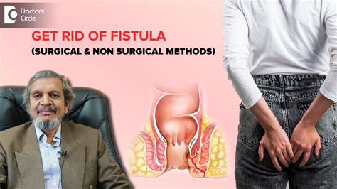 Fistula Surgery Fistulectomy Fistulotomy Procedure Dr Rajasekhar Mr Doctors Circle