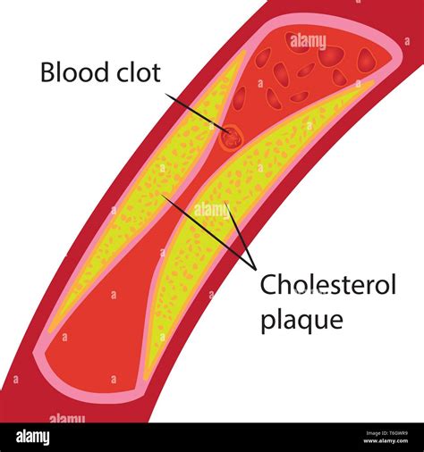 Coágulo De Sangre Y De Colesterol De La Placa Los Vasos Sanguíneos