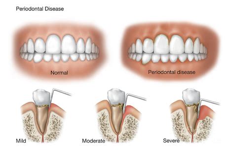 Three Stages Of Periodontal Disease Digital Art By TriFocal