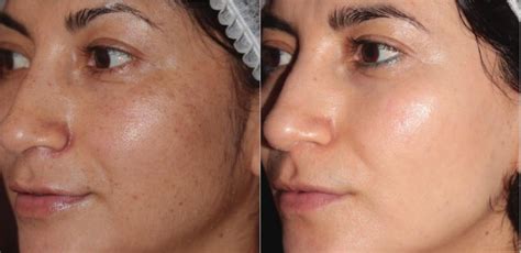 Bbl® Laser Skin Rejuvenation Before And After Photo Gallery Toronto