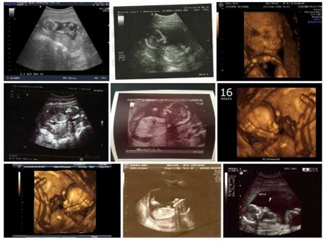Semana 16 De Embarazo Síntomas Desarrollo Fetal Panza Y Ecografía