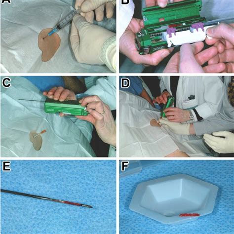 A Components Of The Biopsy Needle Include 1 Trocar 2 Cutting