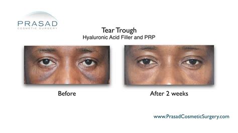Under Eye Filler Before And After Photos Prasad Cosmetic Surgery Ny