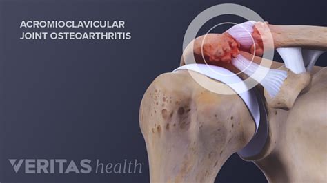 Acromioclavicular Joint Anatomy And Osteoarthritis