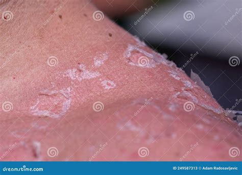 Peeling Sunburned Skin On Back And Shoulder Stock Image Image Of