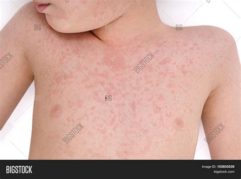 Allergic Reaction Image And Photo Free Trial Bigstock