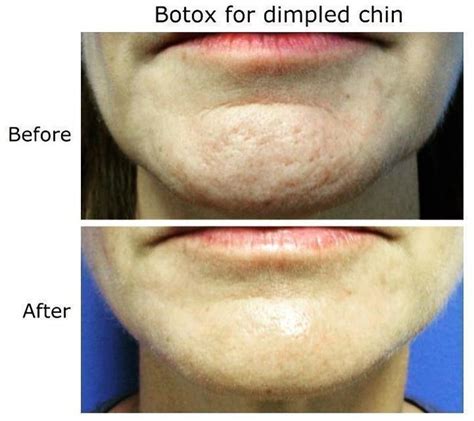 Botox For Dimpled Chin Facial Injections Info Prices Photos