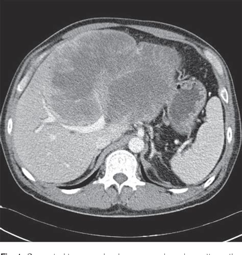 Figure 1 From A Primary Malignant Rhabdoid Tumor In Adult Liver