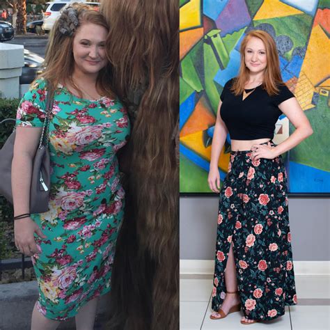Weight Loss Surgery Before And After Photos Soma Bariatrics Los Angeles