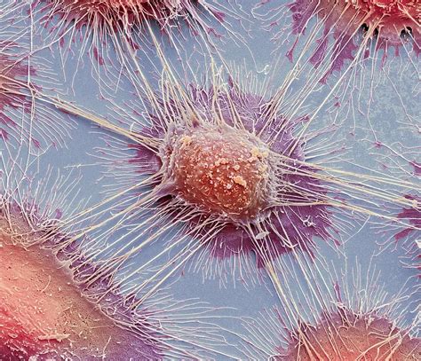 Electron Microscope Images Of Cancer Cells Micropedia