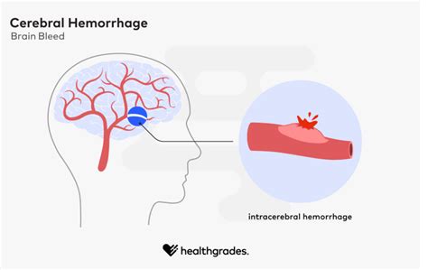 Cerebral Hemorrhage Brain Bleed Symptoms Causes Treatments