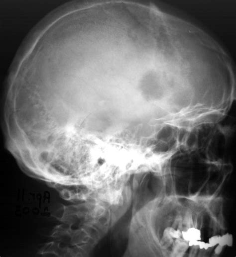 Plain Skull X Ray Film Showing An Irregular Lytic Lesio Open I