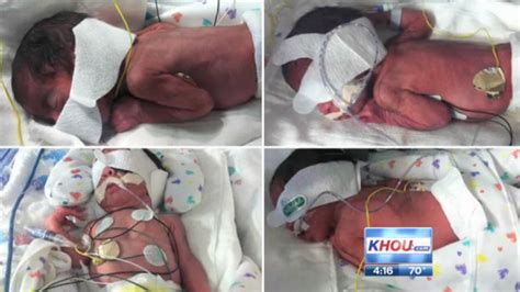 Texas Woman Has 2 Sets Of Identical Twins In One Day A 1 In 70 Million