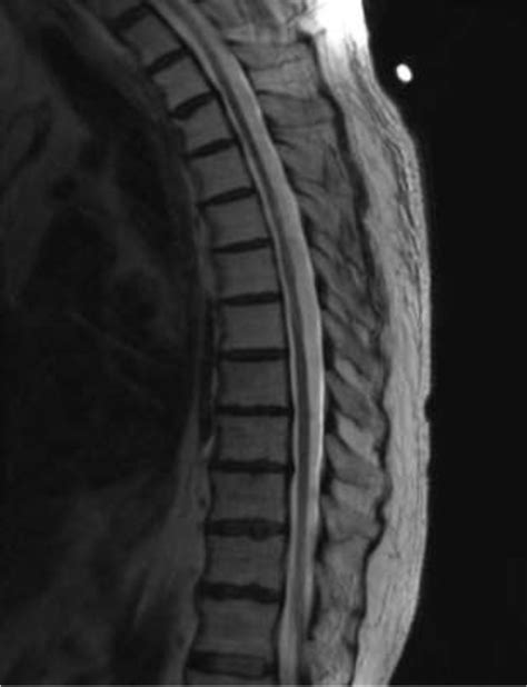 Mri Thoracic Spine Sagittal T2 After 6 Cycles Of Cyclophosphamide