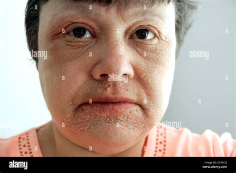 Woman Suffering With Eczema And A Rash Covering Most Of The Face With The