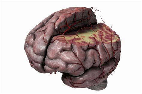 In classical physics and general chemistry, matter is any substance that has mass and takes up space by having volume. White Matter and Your Brain