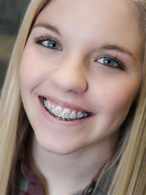 girl face with braces
