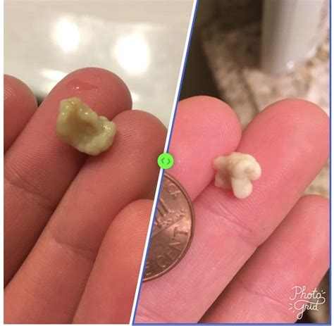 Some Of My Biggest Tonsil Stones Scrolller