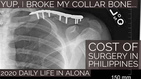 Cost Of Surgery In Bohol Broken Collar Bone Surgery Daily Life In