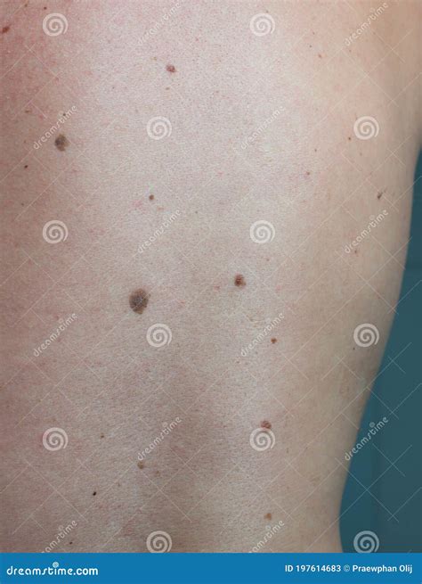 Close Up Skin Problem `melanoma` The Black Spot On Human Back Skin