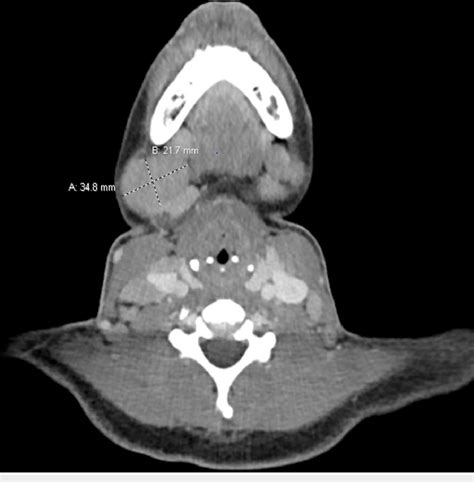 Ct Scan Of Neck With Iv Contrast Showing Bilateral Cervical