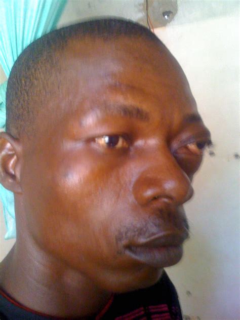 Face Of Zim Man Deformed By Police Beating Now Looks Normal Sunday