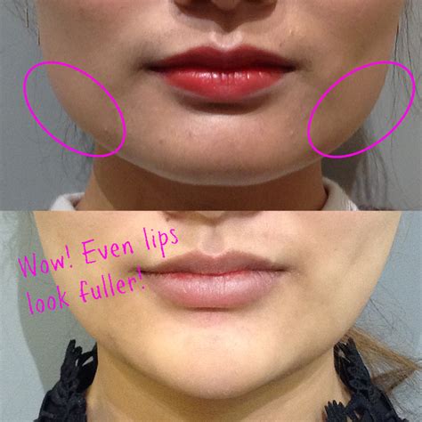 Facial Slimming With Botox Copy Skin By Design Dermatology And Laser