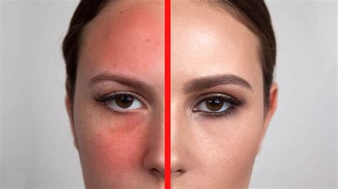 15 Ways To Reduce Redness On Your Face Quickly Redness On Face