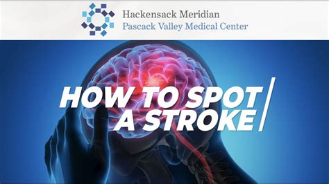 How To Spot A Stroke Youtube