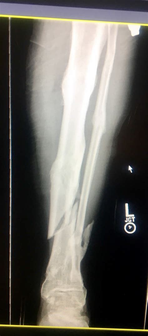 Tibia fracture in athletes - Howard J. Luks, MD